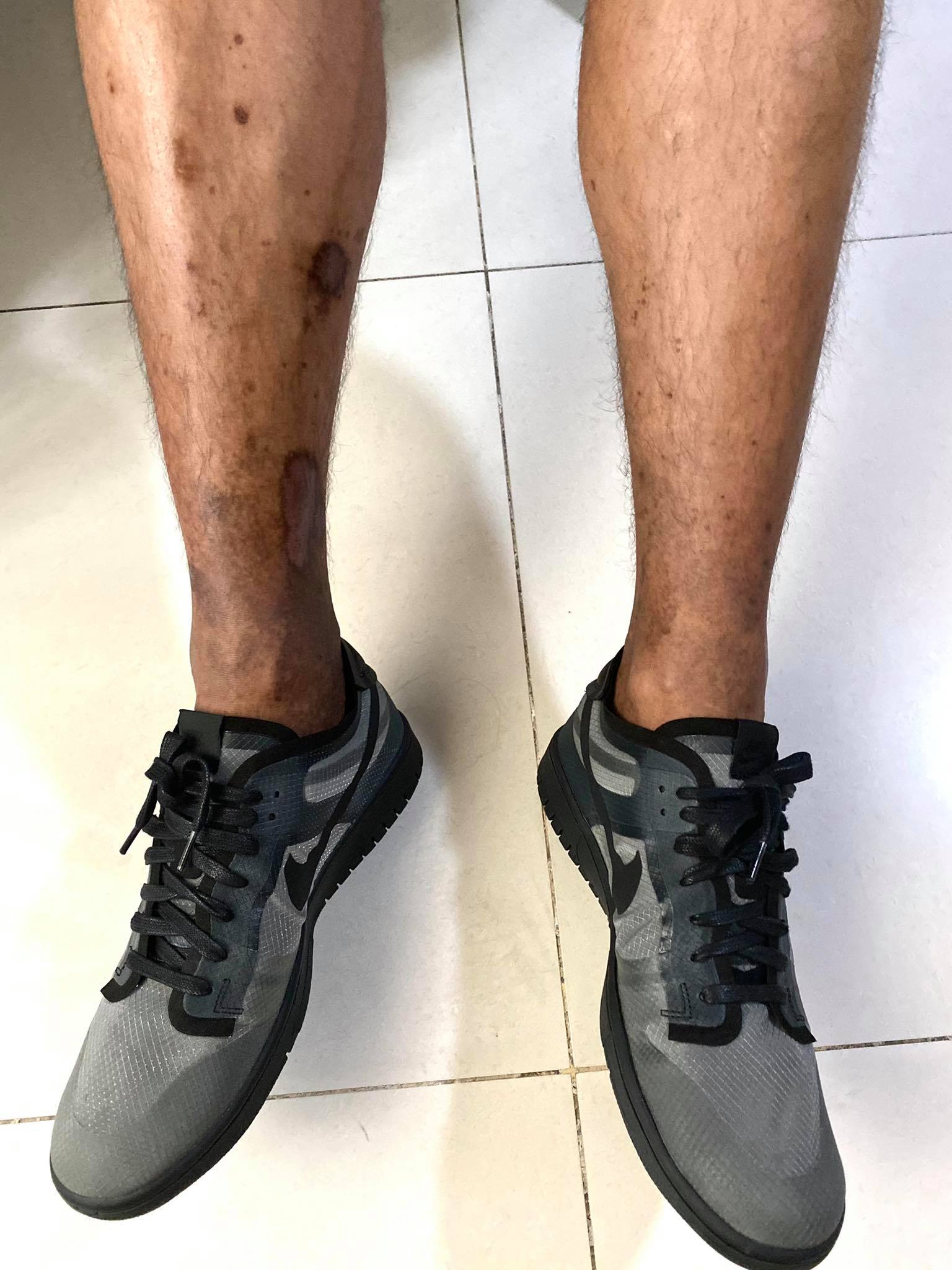PBA-Season-46-Jaypee-Mendoza-legs Jaypee Mendoza shares battle with DVT, road to recovery Basketball News PBA - philippine sports news